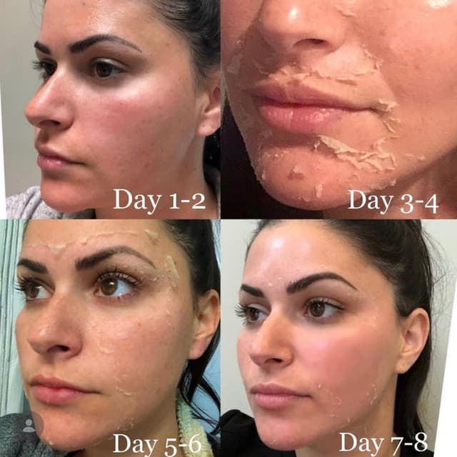 VI Chemical Peel at Spatium Urgent Care & Wellness in Marietta, GA
